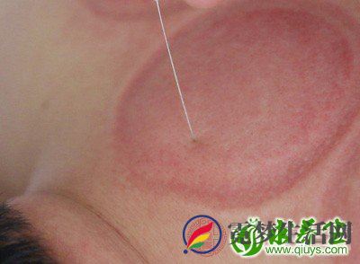 针灸减肥是怎么达到减肥效果的呢 针灸减肥是怎么达到减肥效果的呢