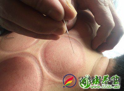 白血病人群不适宜针刺等