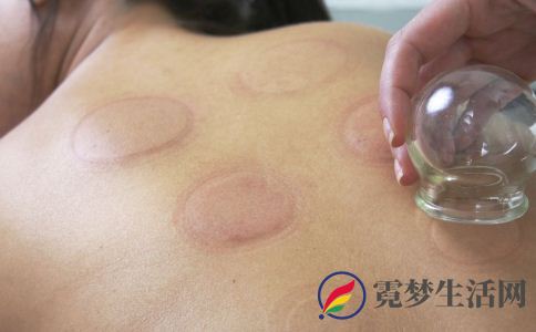 拔罐要注意什么 拔罐颜色跟什么有关 拔罐可以治疗什么