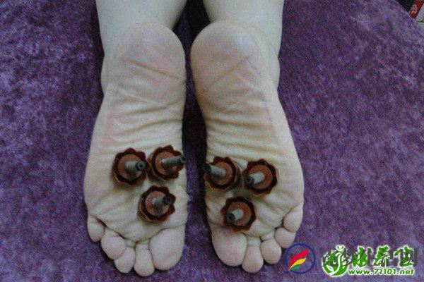 艾灸涌泉的功效和作用 艾灸涌泉穴的禁忌有哪些